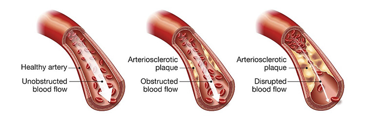 脂肪肝のイメージ