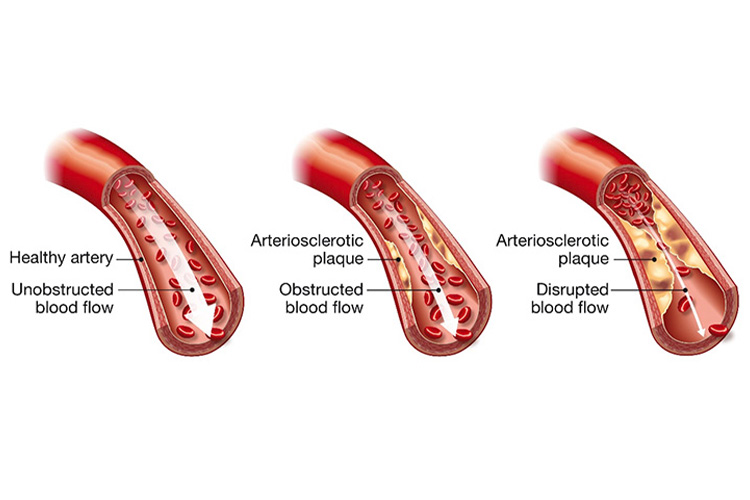 動脈硬化のイメージ