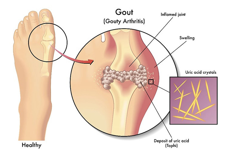 尿酸血症のイメージ