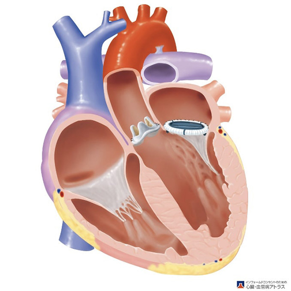 人工弁のイメージ