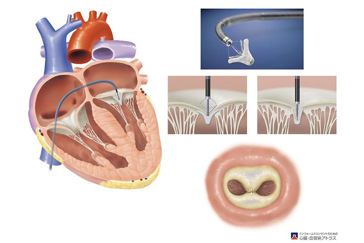 Mitracliのイメージ