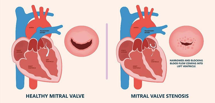 僧帽弁狭窄症のイメージ
