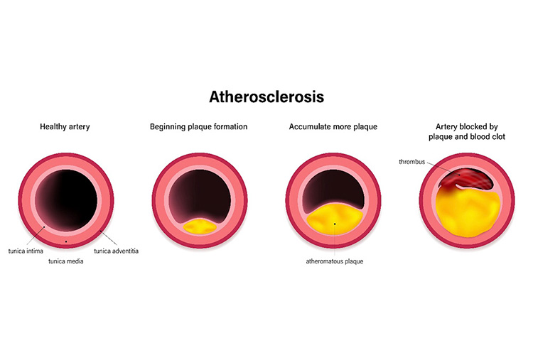 心筋梗塞になる動脈壁のイメージ