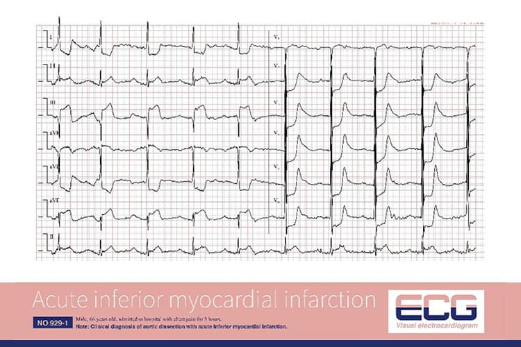 心電図のイメージ