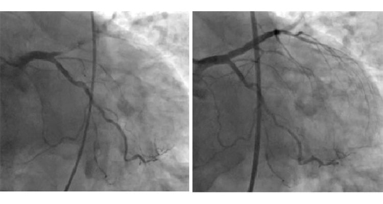 カテーテル治療のイメージ