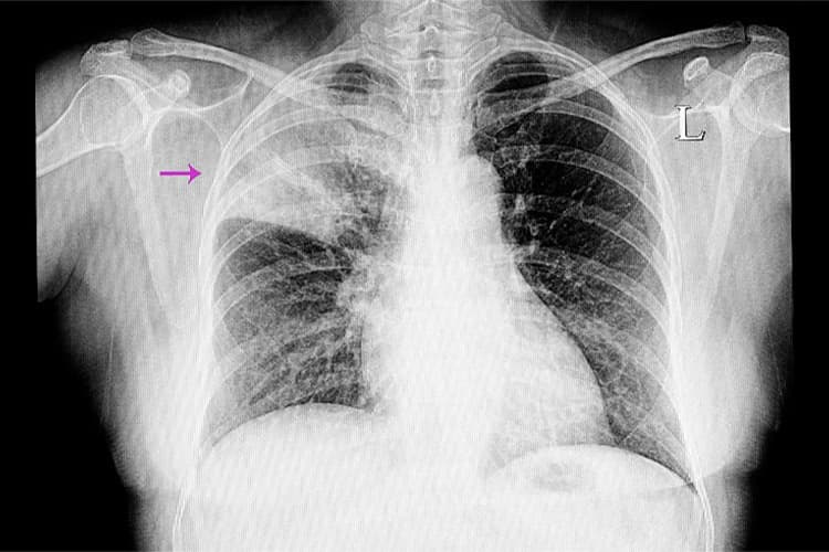 肺炎のイメージ
