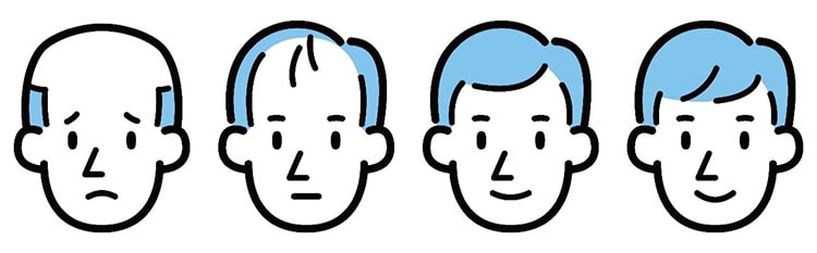 男性型脱毛症のイメージ