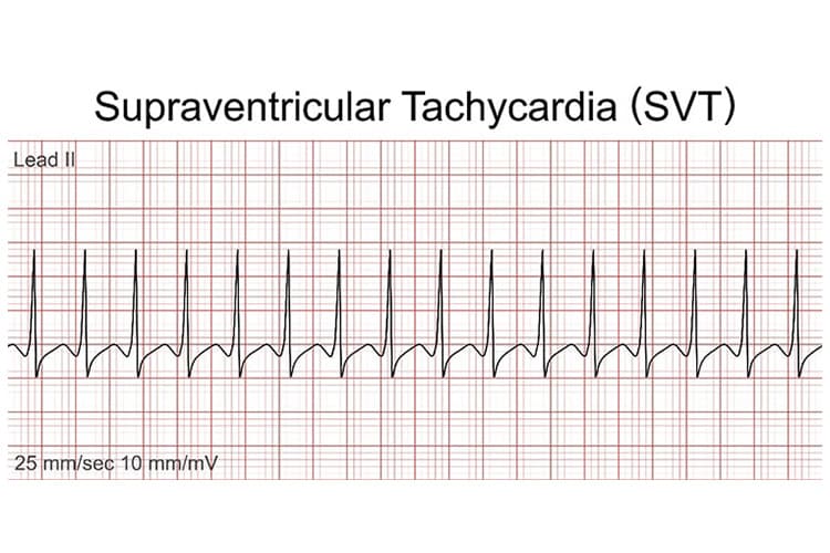 発作性上室頻拍の電気信号