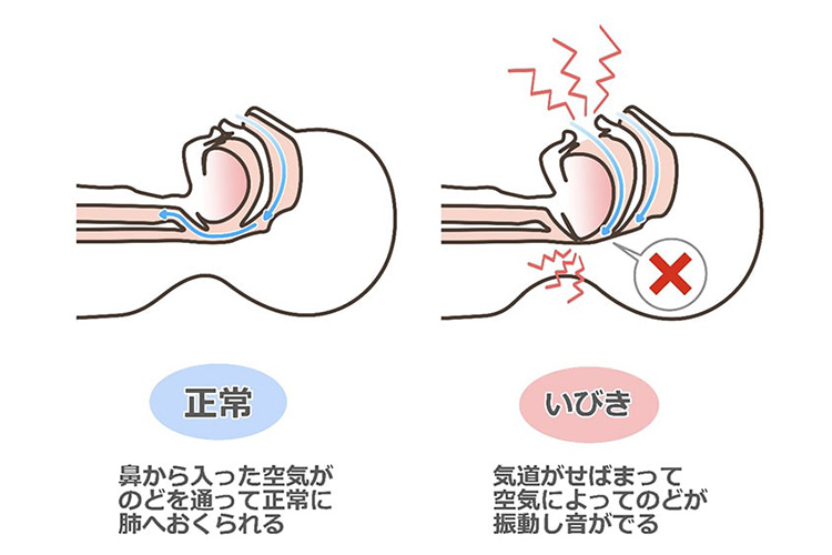 睡眠時無呼吸症候群のイメージ