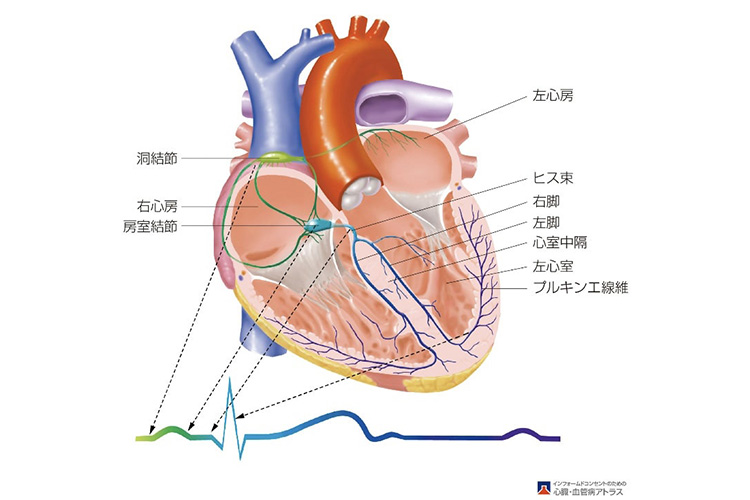 洞不全症候群のイメージ