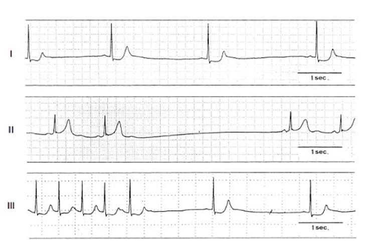 Rubenstein分類の波形イメージ