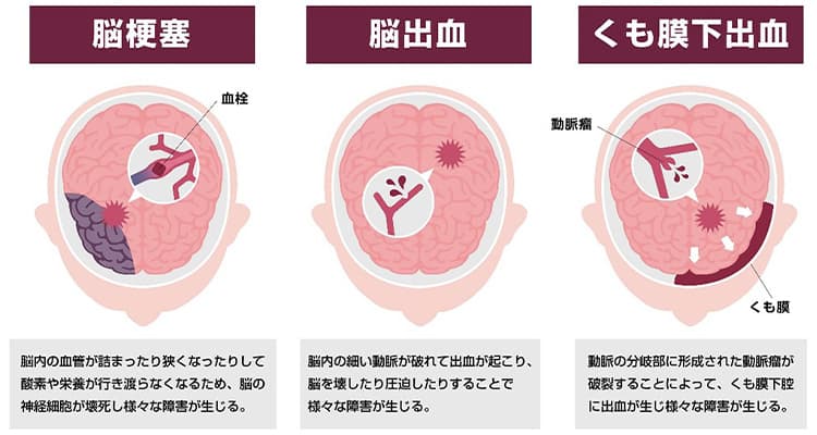 大動脈瘤のイメージ