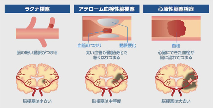 脳梗塞の内訳