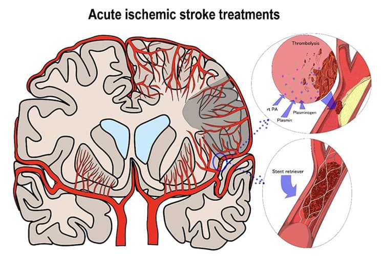 脳梗塞治療のイメージ