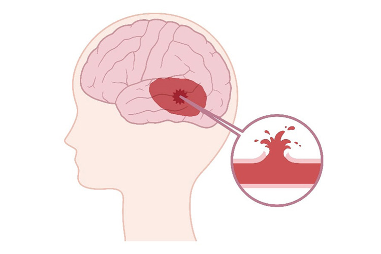 脳梗塞治療のイメージ