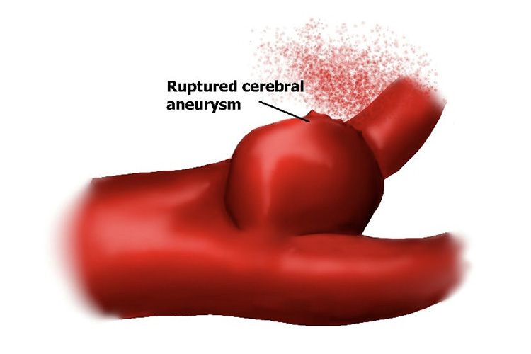 くも膜下出血のイメージ