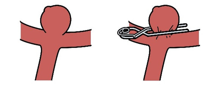 開頭クリッピング手術のイメージ