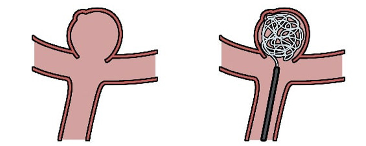 血管内コイル塞栓術のイメージ