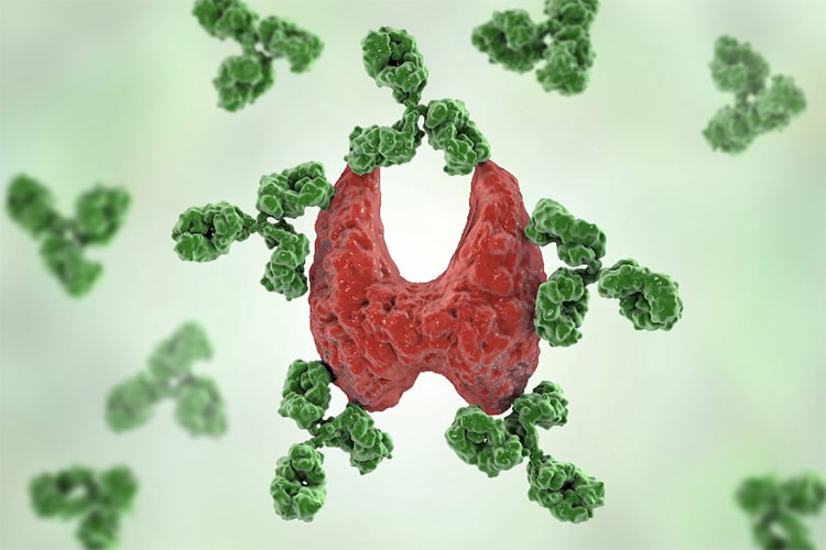 抗体が甲状腺を攻撃しているイメージ