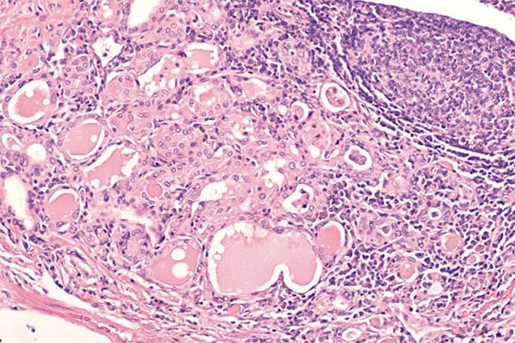 栄養不足での貧血のイメージ