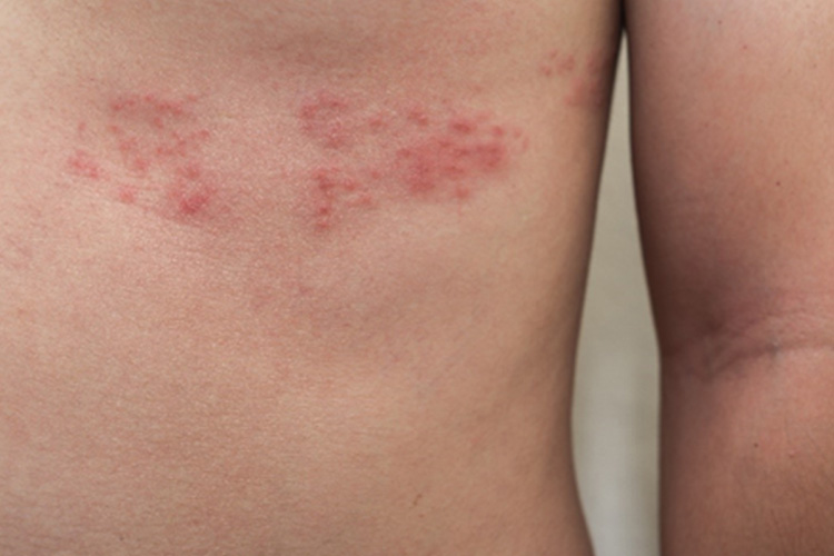 帯状疱疹のイメージ