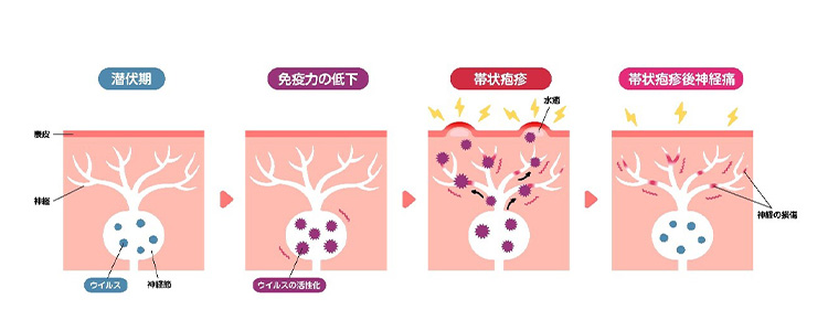 帯状疱疹後神経痛のイメージ