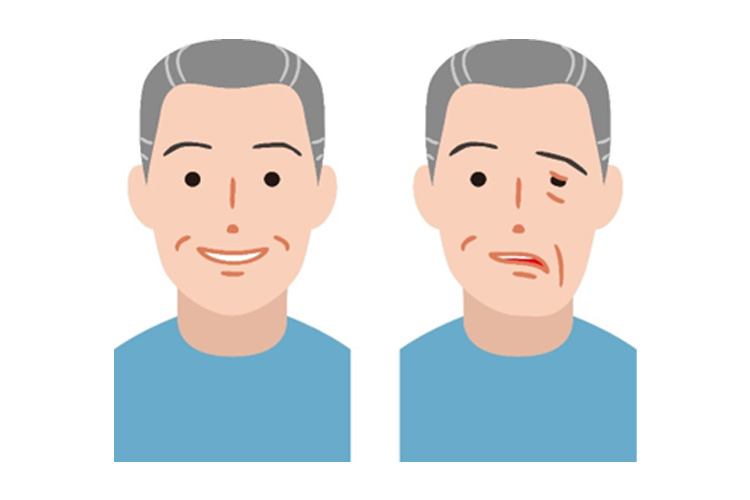 ラムゼイ・ハント症候群のイメージ