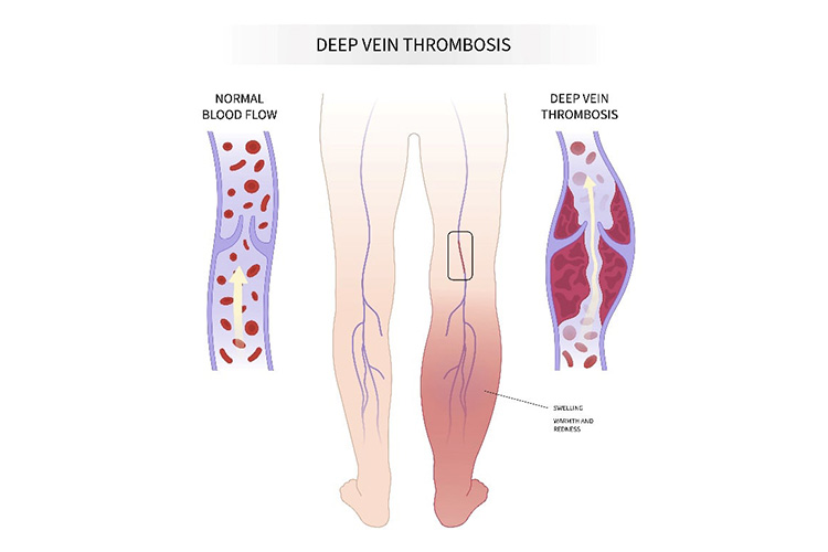 肺血栓塞栓症と深部静脈血栓症のイメージ