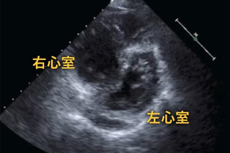 心臓超音波検査のイメージ