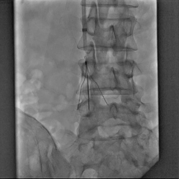 下大静脈フィルターのイメージ